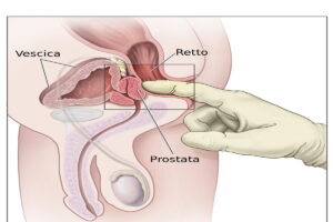 problemi prostata